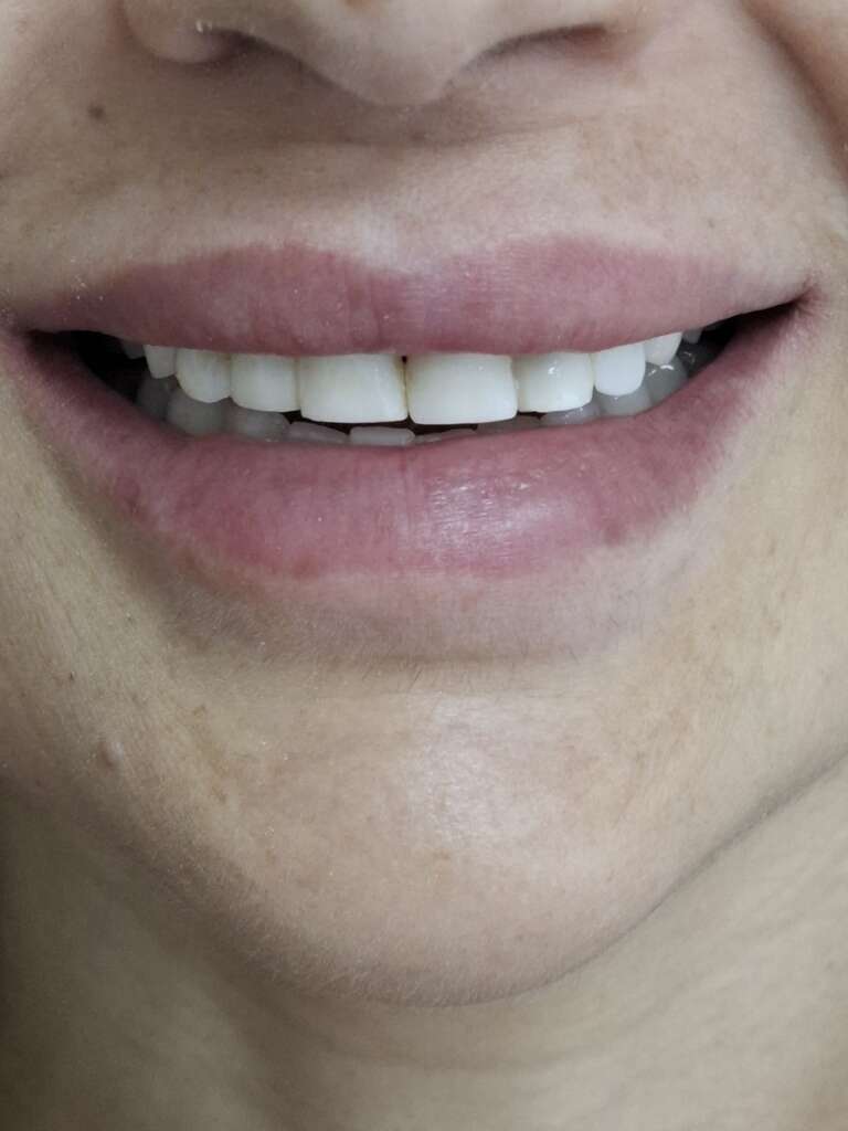 Life changing before and after zirconia case . Enjoy the beauty of this natural hollywood smile 
